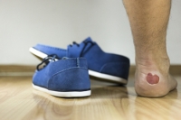 Why Do Blisters Develop?