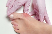 Who Is Prone to Developing Bunions?
