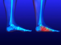 Common Reasons Why Flat Feet May Exist